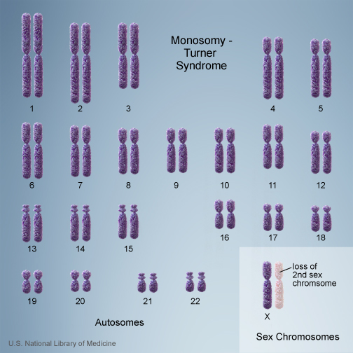 Turner Syndrome